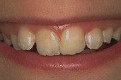 collage de dent cassée