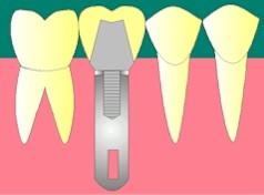 collage de dent cassée