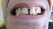 Resultat apres imlplants dentaires. Avant et après implants